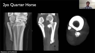 Bone Sequestrum Undetected by Radiograph