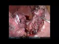 ral partial gastrectomy gist tumor