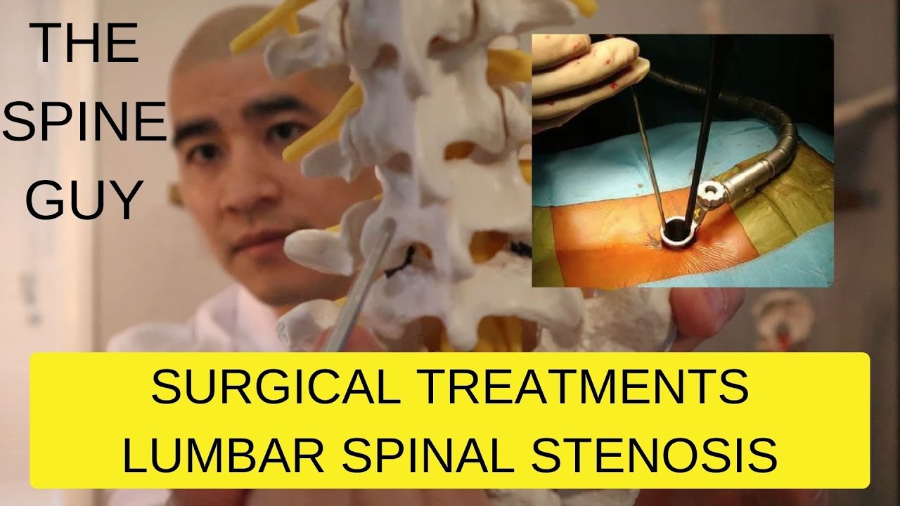 Part 3 - Surgical Treatments For Lumbar Spinal Stenosis - YouTube