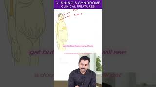 clinical features of Cushing's Syndrome #neetpg #mbbs #next #inicet