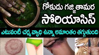 100% Result తోడలు, గజ్జల్లో గజ్జి, తామర, దురద మాయం | Ringworm | Gokudu, Tamara | Psoriasis