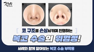 #복코수술 부작용 및 해결 방법! 그에 대한 실제사례, 같이 살펴봐요!