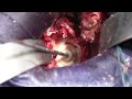 revomotion surgical technique chapter 4 glenoid preparation