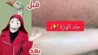 أفضل وأسهل طريقة للتخلص من جلد الوزة او الدجاجة|علاج التقرن الشعري😯