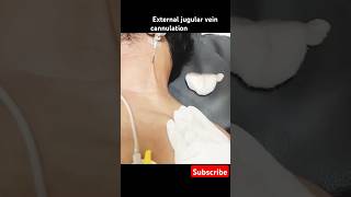 External jugular vein cannula technique #cannula #hospital #medical #subscribe#foryou #youtubeshorts