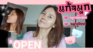 อัพเดทอาการหลังแก้จมูกแบบopen เสริมจมูกแบบopen บวมนานไหม?  | Mamy mind 11