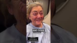 Incredible FACELIFT Results - Surgeon Reacts