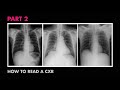 ABCs of Reading a Chest X-ray - How to Read a Chest X-Ray (Part 2) - MEDZCOOL