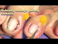 EXTRACTING HUGE JUICY INGROWN TOENAIL