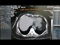 Tuberculosis of Lungs | CT Scan of Chest | Medical Imaging | Dr Green Side | Finding of CT chest