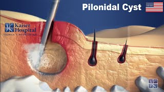 E.P.Si.T. - Endoscopic Pilonidal Sinus Treatment