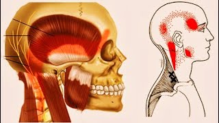 cervicalheadache |ಸರ್ವಿಕೋಜೆನಿಕ್ ತಲೆನೋವು|