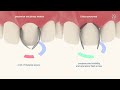 Unica Proximal matrix , new anterior sectional matrix