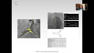 A stent thrombosis noticed during EBC MAIN - Dr Antoinette Neylon