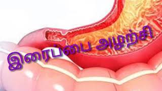 இரைப்பை அழற்சி / gastritis in Tamil