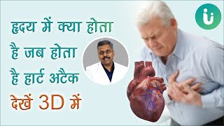 हार्ट अटैक से पहले मिलने वाले लक्षण, कारण व इलाज - कैसे होता है हार्ट अटैक - Heart attack in Hindi