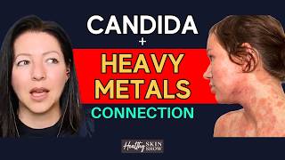 Tough Truth About Oxalates, Kidney Stones & Candida Overgrowth (Before You Do A Low Oxalate Diet)