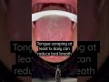 Tongue scraping 1xdaily can reduce bad breath #badbreath #howtogetridofbadbreath #dentalcare #tongue