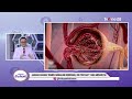 dokter jawab pertanyaan netizen benarkah kencing jongkok lebih sehat hidup sehat tvone