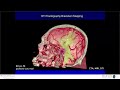 brainstem cavernous malformation resection outcomes massin congress day 1 session 2 talk 1