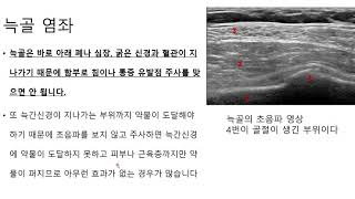 늑골염좌 통증 치료에는 초음파로 보면서 하는 늑간신경치료가 가장 효과가 좋고 안전합니다