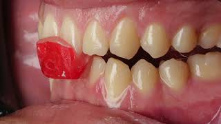 Occlusal Splint I : Centric Relation Record