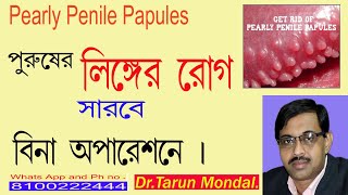 পুরুষের লিঙ্গের সমস‍্যা।পুরুষের লিঙ্গের রোগ। Pearly Penile Papules কি লক্ষণ ও হোমিওপ্যাথি  চিকিৎসা।