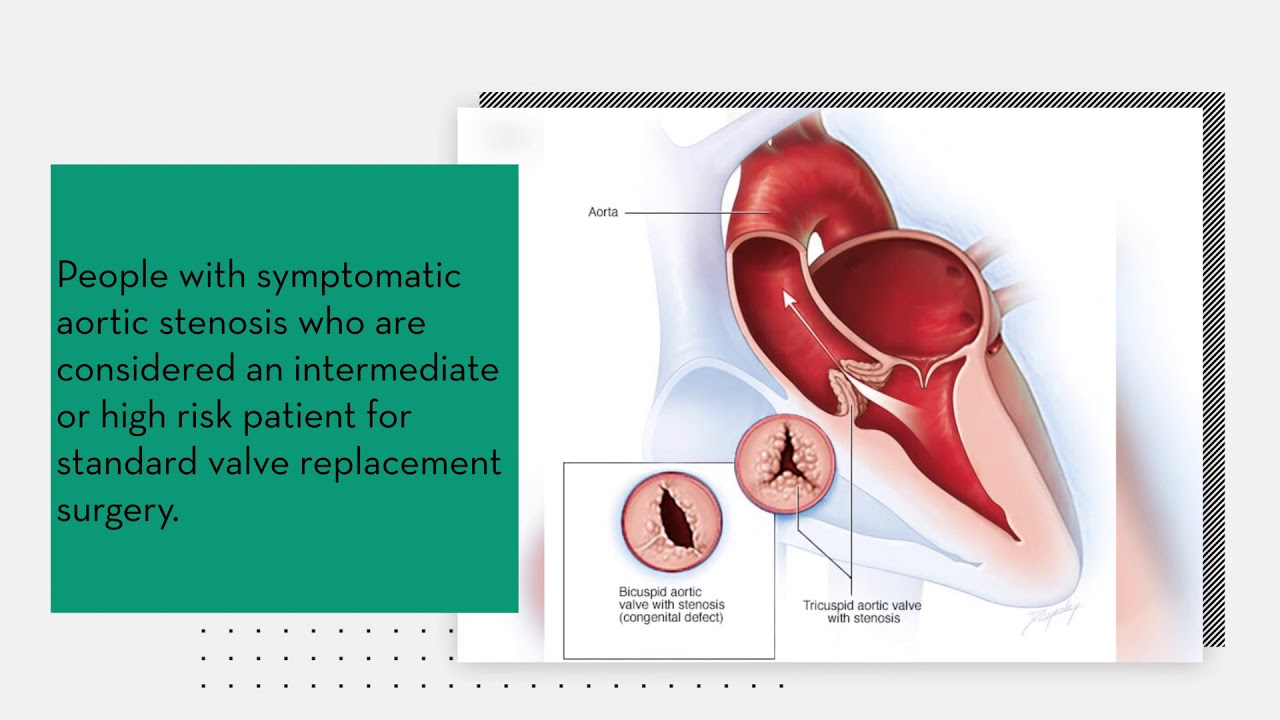 TAVI OR TAVR Procedure For Valve Replacement Explained Dr. Viveka Kumar ...