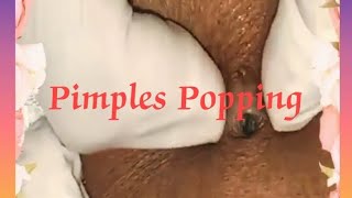 Pimple \u0026 Blackheads Popping - 44