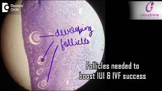 How many follicles do you need to boost IUI or IVF success?- Dr. Radhika Seth of Cloudnine Hospitals