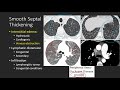 Septal Thickening