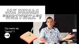 JAK DZIAŁA ''WSZYWKA''? ESPERAL DISULFIRAM - CZY WARTO SIĘ ZASZYĆ?