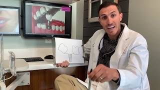 Why You Should Straighten Teeth Before Getting Implants