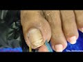 vlog 614 dry skin ingrown removal pedicure 514