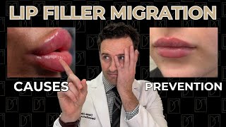 Lip Filler Migration: Cause & Prevention