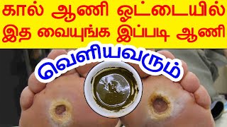 1 மணி நேரத்தில் கால் ஆணி இப்படி வெளியவரும் | kaal aani treatment in tamil | health tips in tamil