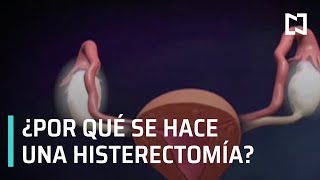 Histerectomía - Expreso de la Mañana