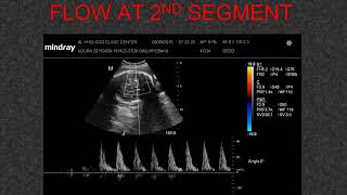 Case 32 Fetal MCA doppler