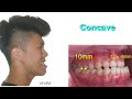 nonsurgical correction of a severe class iii malocclusion with miniscrews｜【chris chang ortho】cc424