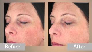 How LYTERA™ Skin Brightening Complex Works