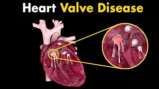 how heart valve disease occurs?Symptoms , Diagnosis and Treatment