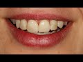 veneers made of prettau® 4 anterior® zirconia zirkonzahn.galleries