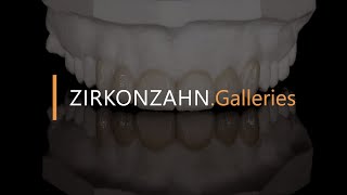 Veneers made of Prettau® 4 Anterior® zirconia | Zirkonzahn.Galleries