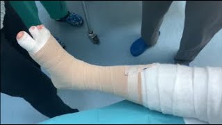 Compression Bandaging for lymphedema of the leg