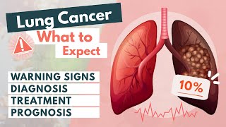 Lung cancer: What to expect? | Symptoms, Diagnosis, Treatment & Prognosis