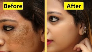 How to Remove Skin pigmentation from face? - Beauty Tips in Tamil