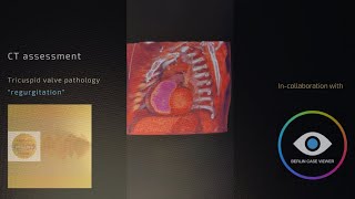 CT assessment - tricuspid regurgitation (basics)