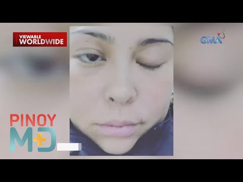 Angelu de Leon shares her fight with Bell’s Palsy Pinoy MD