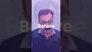 Hair Patch Fixing through Clips | Clip-In Hair Patch Service In Delhi NCR |Hair Patch For Men's