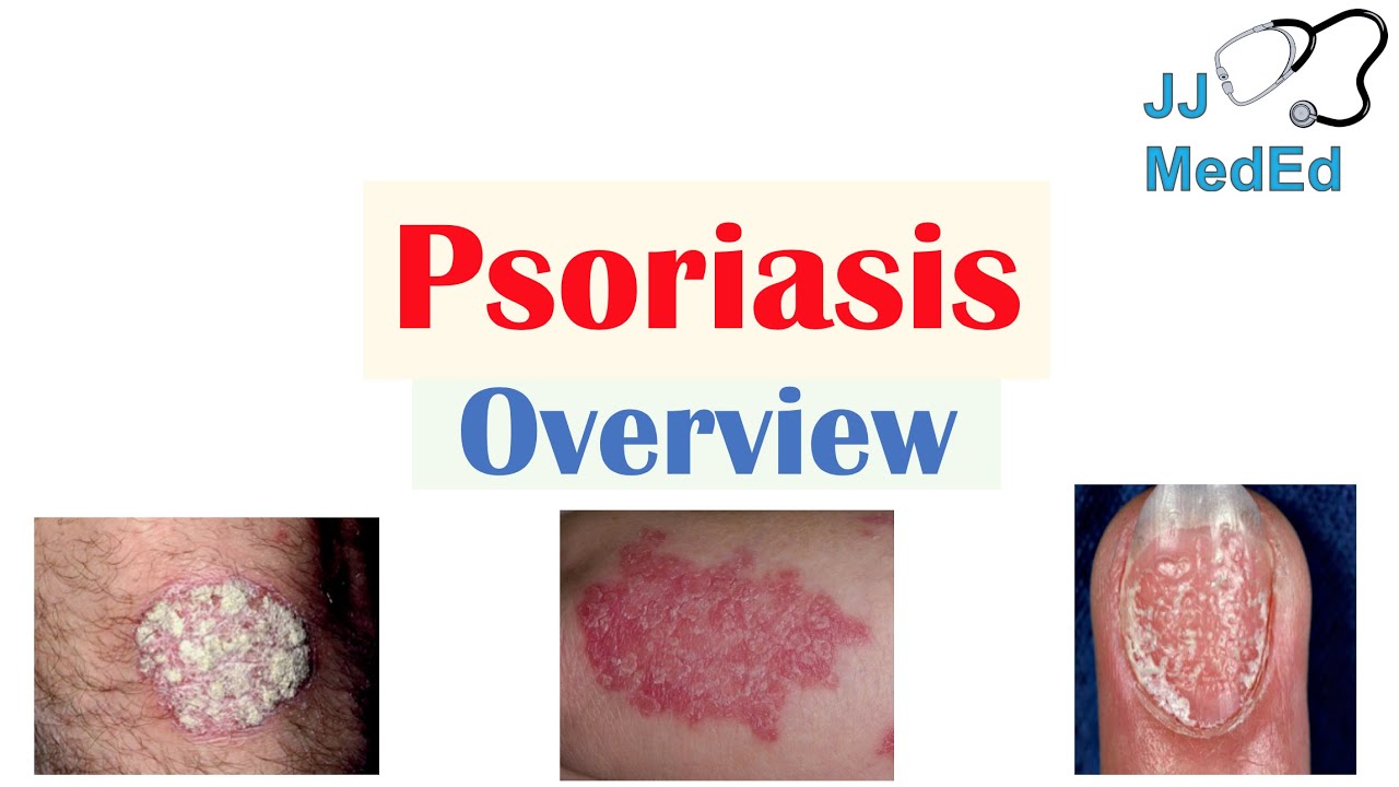 Overview Of Psoriasis | What Causes It? What Makes It Worse? | Subtypes ...